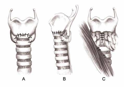 240 Şekil 13: Anastomoz hattı orta hatta tekrar birleştirilen tiroid istmusu ile, diseksiyon sırasında ortaya çıkan