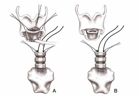 BÖLÜM 13a Subglottik Darlıklarda Cerrahi Tedavi 243 Şekil 16: Krikoid kıkırdağın posterior tablasının üzerindeki avasküler subperikondral alan küçük bir ortopedik elevatör ile aritenoid kıkırdakların