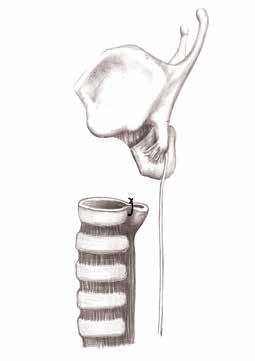 244 Şekil 17: Pearson tekniğinde Grillo nunkinden farklı olarak distal trakea çapını subglottik seviyede daha dar olan hava yolu çapına uygun hale getirmek amacıyla trakeanın ilk halkasının posterior