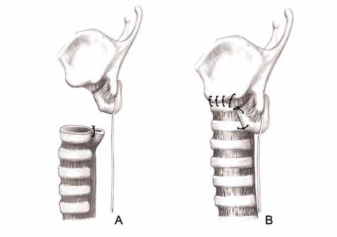 BÖLÜM 13a Subglottik Darlıklarda Cerrahi Tedavi 245 Şekil 18: Anastomozun kalan kısmı yine çepeçevre separe emilebilir dikişlerle yapılarak tamamlanır. rikülde yerleşir (Şekil 21).