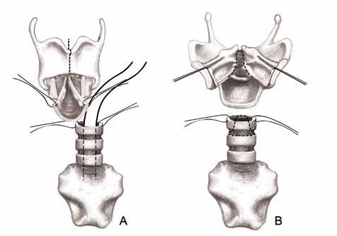 246 Şekil 19: A: Stenozun posteriorda interaritenoid bölgeye kadar uzandığı durumlarda Pearson operasyonuna laringofissür de eklemiştir.