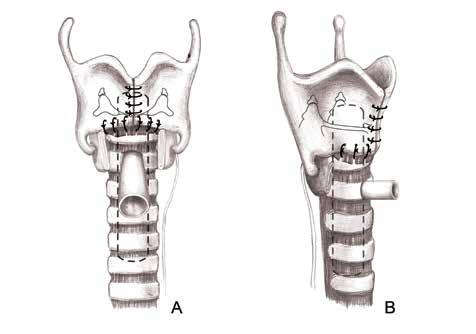 248 Şekil 21: Posterior ve lateral dikişler tamamlandıktan sonra lümen içine T-tüp konularak proksimal ucu laringeal ventriküle kadar ilerletilir.