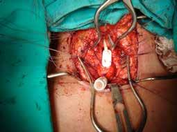250 Resim 9: Orolaringeal yolla gönderilen jet kanülü T-tüpün içerisinden distal akciğere ilerletilerek anastomoz dikişleri kanül sağa ve sola çekilmek suretiyle etrafından rahatlıkla konulabilir.