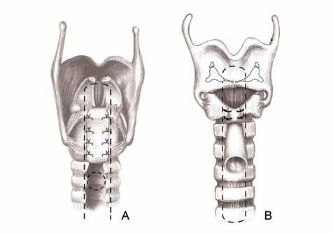 252 Şekil 23: Couraud tekniğinin posterior ve anterior açıdan bitmiş görünümlerinde yine proksimal kolu laringeal ventriküle kadar ilerletilen T-tüp dikkati çekmektedir.