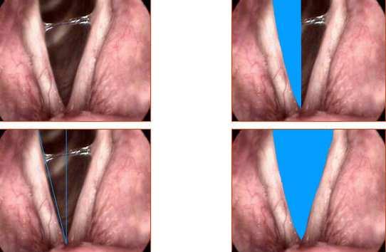Posterior kordektomi sonrasında, fonasyonda vokal foldların, orta hattın görüntüleri ve alan açı