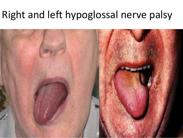 N. hypoglossus lezyonu Dilin ipsilateral yarımında bu sinir tarafından innerve edilen dil kaslarında paralizi ve atrofi görülür.