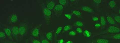 Çekirdek Granüler + Granüler Kromozom Dfs70 (+) olabilir