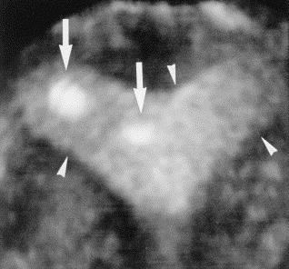 Where does the embryo implant after embryo transfer in humans?