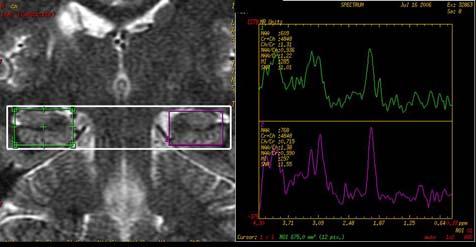 ÇELİKYAY YÜKSEKKAYA Z.R. ve Ark., Temporal Lob Epilepsisinde Mr Spektroskopinin F.Ü. Sağ. Bil. Tıp Derg.