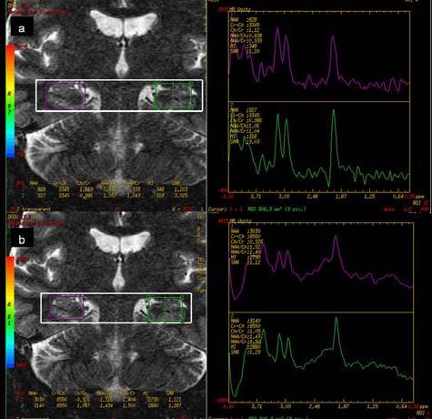 Cilt : 23, Sayı : 2 Temporal Lob Epilepsisinde Mr Spektroskopinin Temmuz 2009 Şekil 10.