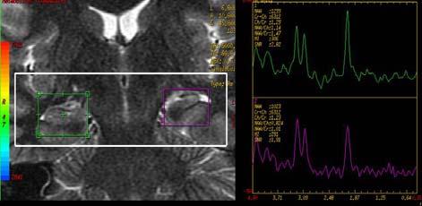 Şekil 12. TLE tanılı ve travma öyküsü bulunan olguda EEG de sağa lateralize MRS de TE 135 ms de (a) NAA/Cho ve NAA/Cr, TE 35 ms de (b) NAA/Cr oranlarında azalma saptanmıştır. Şekil 13.