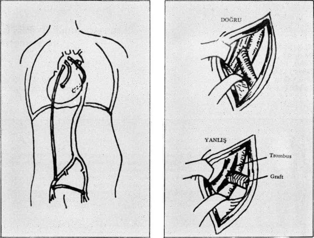 Axillo-femoral by-passlarda proximal anastomozun şekli. Şekil-2.