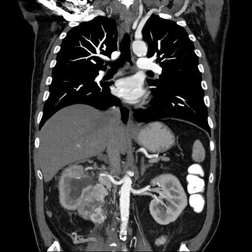 Soru 5 RT, 58 y, E Sağ yan ağrısı BT: Sağ alt pol-hilus 85x65 mm kitle Renal vende trombüs var,