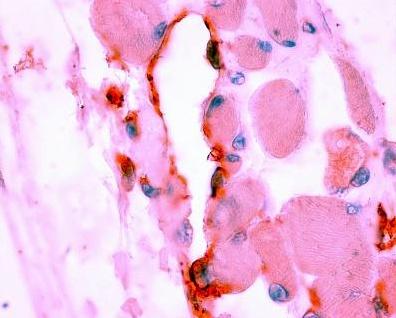 inflamatuar hücrelerin damar dışına çıkıp alveol içine geçişi Tip 1
