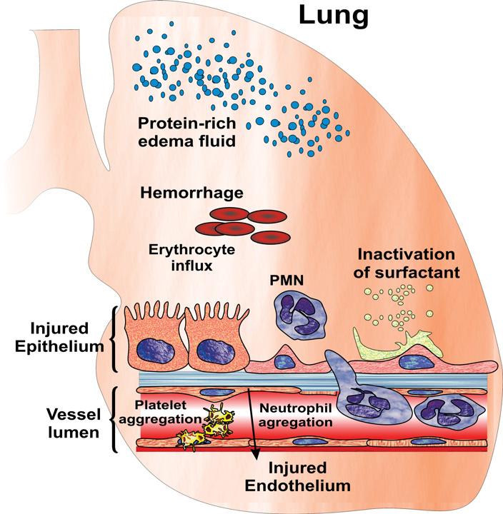 PATOFİZYOLOJİ VE PATOGENEZ Hücre hasarı Sürfaktan kaybı Atelektazi Proteinöz alveoler ödem ( vasküler permeabilite ) Artmış sağ-sol şant Azalmış FRC Artmış fizyolojik ölü boşluk Azalmış pulmoner