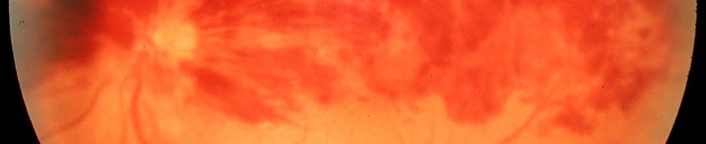 Retina damarlarının perfüzyon basıncı, kan basıncı ile GİB in farkına eşittir. GİB de yükselme veya kan basıncında düşme göz perfüzyonunu bozar.