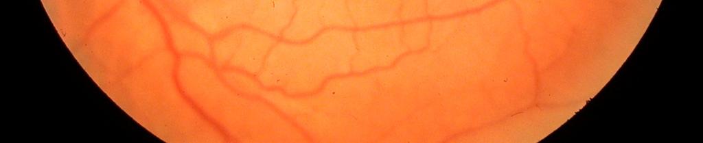 Sonuçta santral retina veninde staz oluşarak pıhtı meydana gelir. 36 Yapılan çalışmalarda PAAG de kan viskozitesi ve eritrosit agregasyonunda artış ve kan hızında azalma saptanmıştır.