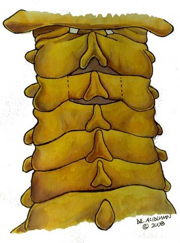 6 spinosus lar palpe edilerek paramedian olarak koter yardımıyla açılır. Subperiostal olarak kas grupları birbirinden ayrılmadan diseke edilir.