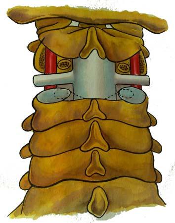 ve pediculus arcus vertebrae nin arka taraftan görünüşü. For.