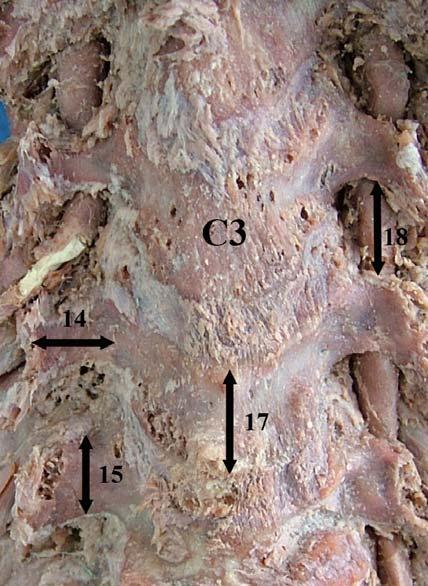 Corpus vertebrae üst ve alt bölümleri arasındaki mesafe