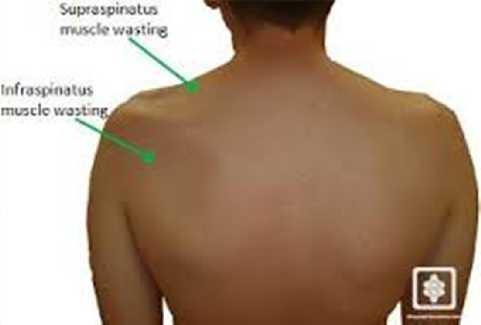 N. Suprascapularis hasarı Kolun abdüksiyon hareketinin başlatılmasında güçlük olur (m. supraspinatus).