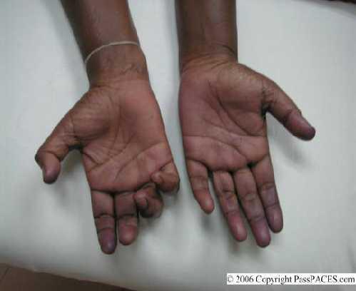 Dördüncü ve beşinci parmağın metakarpofalangeal eklemlerinde belirgin hiperekstensiyon, interfalangeal eklemlerinde fleksiyon vardır.