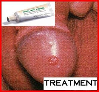 Genital Herpes - Tedavi