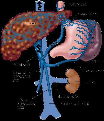 PORTAL HİPERTANSİYON Ömer ŞENTÜRK Tanım Portal ven sist. basınç 5-10 mmhg (~ 7 mmhg) 12 mmhg veya 150 mm su düzeyini aşarsa = Portal Hipert.