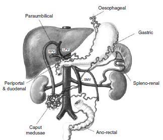 Kollaterallerin Oluştuğu Anatomik Yerler Kollaterallerin Oluştuğu Anatomik Yerler Porto-Kaval anastomozlar (Hepatofugal akım) Portal sistem içinde basınç arttığında belirginleşirler ve portal kanı