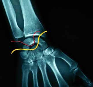 Tanı Perilunat kırıklı-çıkıklı hastada şiddetli el bilek ağrısı, şişlik ve krepitasyon görülür. El bileğinin dizilimi bozulmuştur.