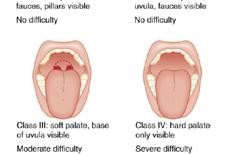 HSE Preparation (-10 min) Preoxygenation (-5 min) Pretreatment (-3 min) Paralysis with induction (0) Protection with position (+20 sec) Placement of the