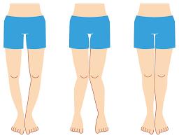cavus), X bacak (genu valgum), O bacak (gene varum) Bacak uzunluk farkları