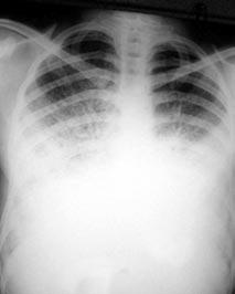 Deniz Ö. ve kosto-diyafragmatik sinüsler görülmeyebilir (Resim 1) (2,13,16,18). Bazı hastaların PA akciğer grafilerinde siyah plevral hat (black pleural line) gözlenebilir (13,23-26).