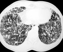 (23-26). Bazı hastaların akciğer grafilerinde bilateral retikülonodüler infiltrasyon görülebilir.