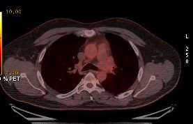 2013 PET/CT: