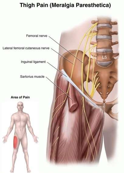 Klinik!!! Sinir, lig. inguinale altından geçtiği esnada sıkışabilir.