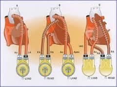 Ventriküler Destek Cihazı (VAD) Takılan ventrikülün performansını