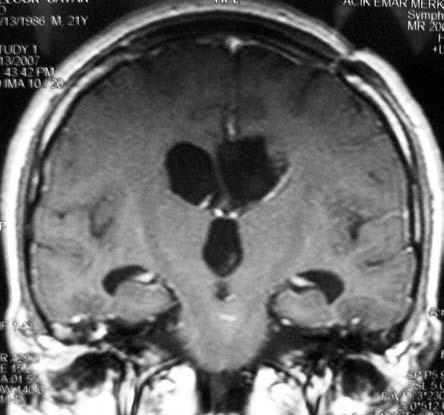 Nüks veya rezidü tümör dokusu saptanmadı. sonucu Santral Nörositoma olarak bildirildi.