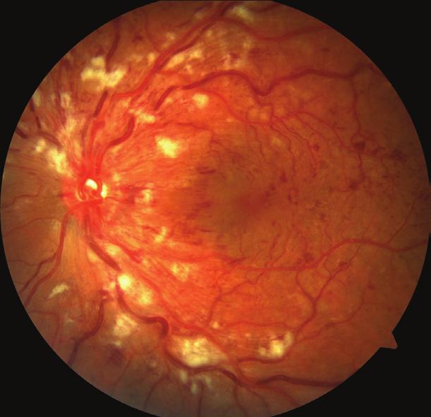 Venöz tromboz riskinde artış olduğu bilinen ülseratif kolit özellikle genç erişkin hastalarda santral retinal ven oklüzyonunun nadir karşılaşılan inflamatuar bir
