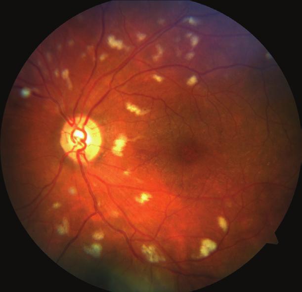 3,4 u yazıda santral retinal ven oklüzyonuna ikincil maküla ödemi nedeniyle başvuran 36 yaşında bir ülseratif kolit hastası sunularak tedavi sırasında karşılaşılan