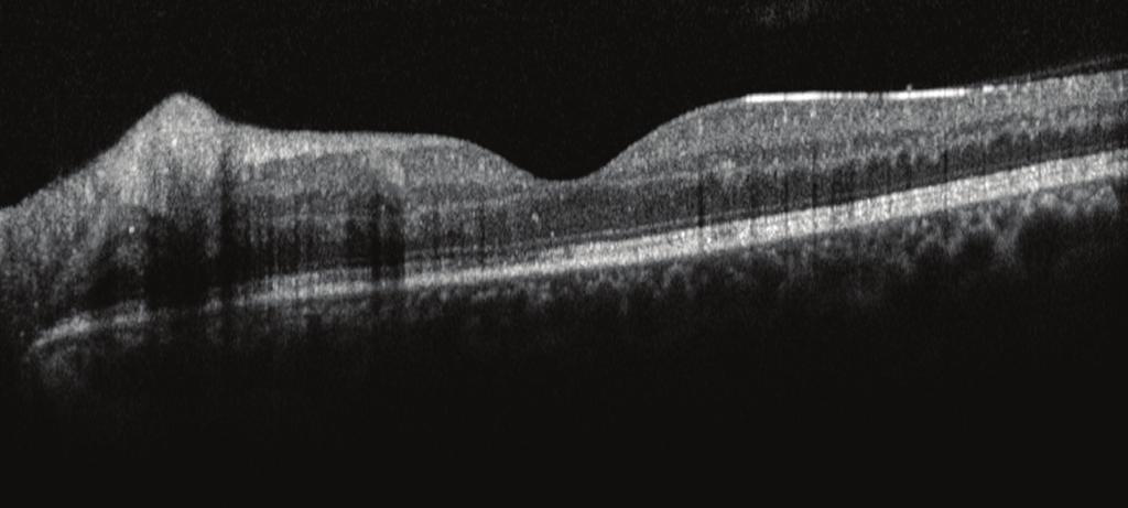 Yapılan oftalmolojik muayenesinde sağ göz bulgularının doğal olduğu (Resim 1a), sol gözde görme keskinliğinin 20/400 düzeyinde ve göz içi basıncının (Gİ) 16 mmhg