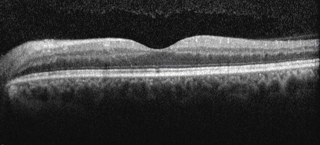 iyomikroskopik ön segment muayenesi normal sınırlarda olan hastanın dilatasyonlu fundus muayenesinde sol gözde dört kadranda yaygın hemorajiler, dilate venler,