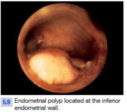 <1cm Endometrial Poliplerde Ofis