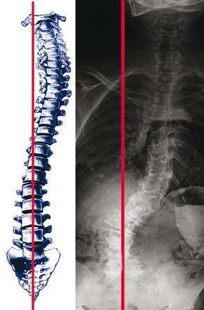 Figure 14: If the spine is either on the right or the left of the CSVL, then imbalance is in effect. In the evaluation of AIS, the presentation of the apical spine is very important.