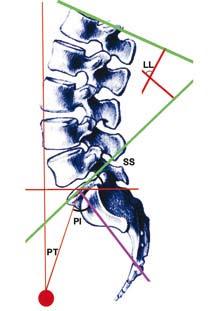 90 fiekil 4: Duval-Beaupere yöntemi ve pelvik insidans aç s görül- Figure 4: The Duval-Beaupere technique using the pelvic incidence (SS = sacral slope, PI = pelvic incidence, PT = pelvic tilt) about