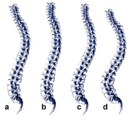 Sagittal and Coronal Balance in the Spine 91 Without harmony in the spine Harmonious, but a flat spine Harmonious spine Harmonious, but a lordotic spine Figure 5: Spine classification according to