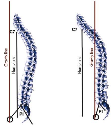 Sagittal and Coronal Balance in the Spine 95 Figure 12: Arching the back of the pelvis is a compensation mechanism. When the PI angle and PT increase, the SS decreases.