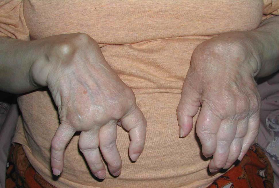 Romatoid artrit En az bir eklemi tutan, zaman