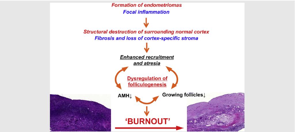 The burnout hypothesis may explain the mechanism partly responsible for the reduced ovarian reserve in women with endometriomas.