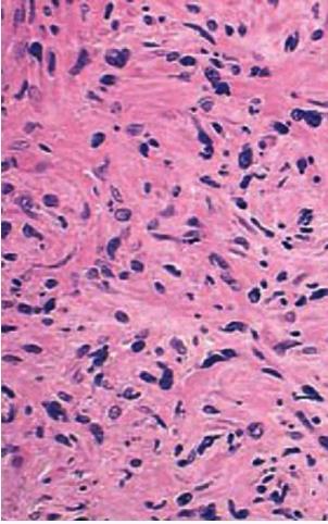 Primer Myelofibrozis(PMF) kemik iliğinde fibrotik